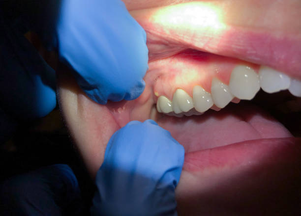 Best Emergency Denture Repair in Boaz, WV